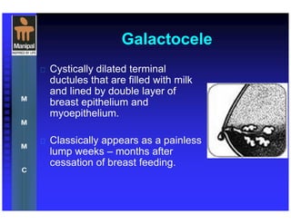 Galactocele
 Cystically dilated terminal
ductules that are filled with milk
and lined by double layer of
breast epithelium and
myoepithelium.
 Classically appears as a painless
lump weeks – months after
cessation of breast feeding.
 