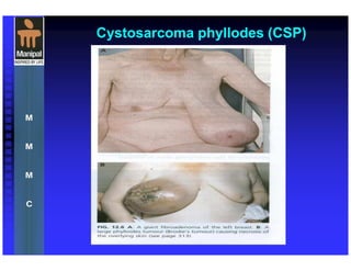 Cystosarcoma phyllodes (CSP)
 