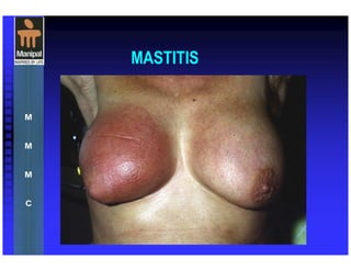 MASTITIS
 