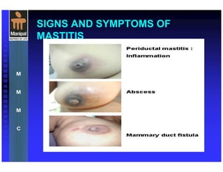 SIGNS AND SYMPTOMS OF
MASTITIS
 