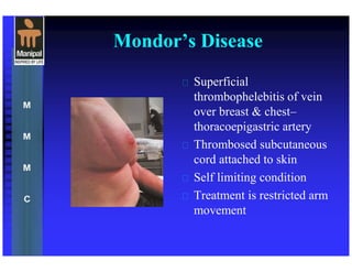 Mondor’s Disease
 Superficial
thrombophelebitis of vein
over breast & chest–
thoracoepigastric artery
 Thrombosed subcutaneous
cord attached to skin
 Self limiting condition
 Treatment is restricted arm
movement
 
