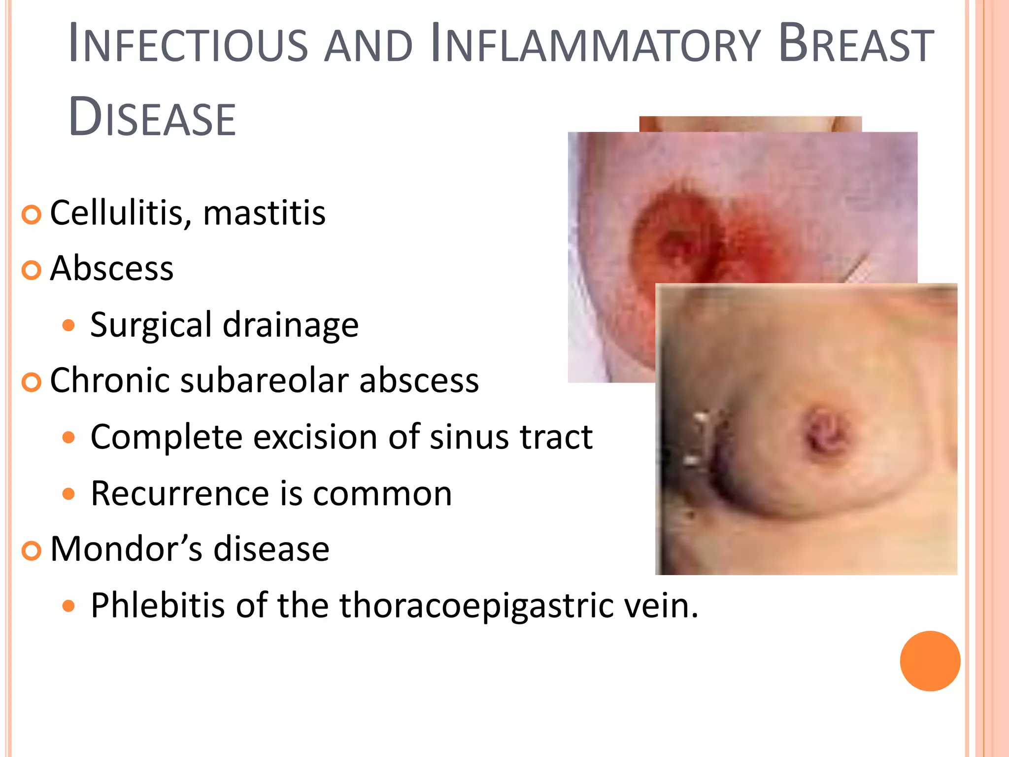 Benign breast disease | PPT