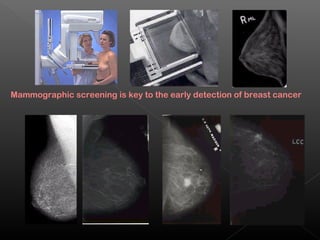 Mammographic screening is key to the early detection of breast cancer
 