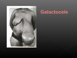 Galactocele
 