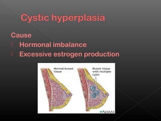 Cause
 Hormonal imbalance
 Excessive estrogen production
 