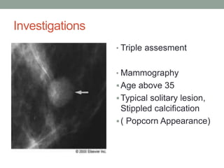 Investigations
• Triple assesment
• Mammography
Age above 35
Typical solitary lesion,
Stippled calcification
( Popcorn Appearance)
 