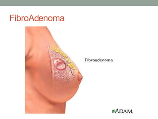FibroAdenoma
 