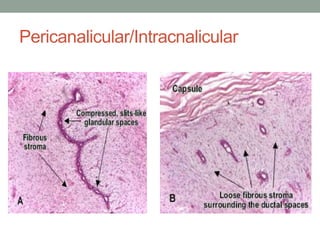 Pericanalicular/Intracnalicular
 