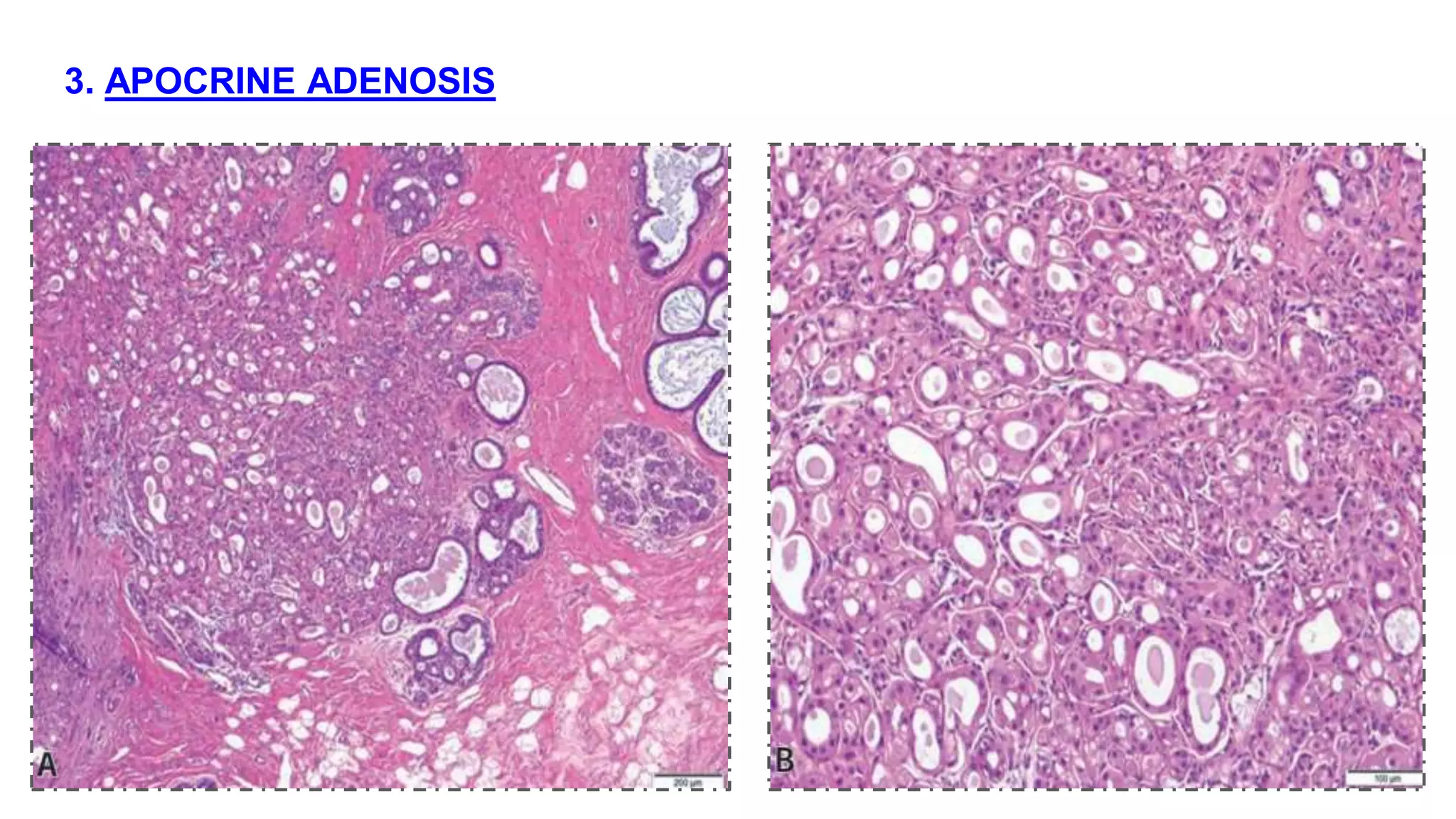 BENIGN BREAST DISEASES PATHOLOGY pptx benign-breast-diseases-pathology-pptx