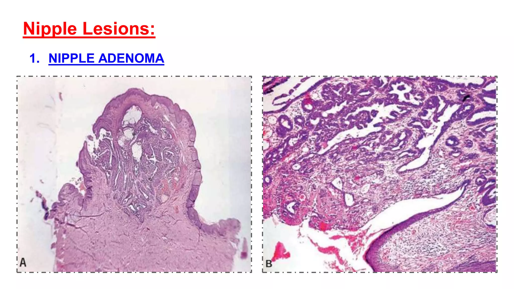 BENIGN BREAST DISEASES PATHOLOGY pptx benign-breast-diseases-pathology-pptx