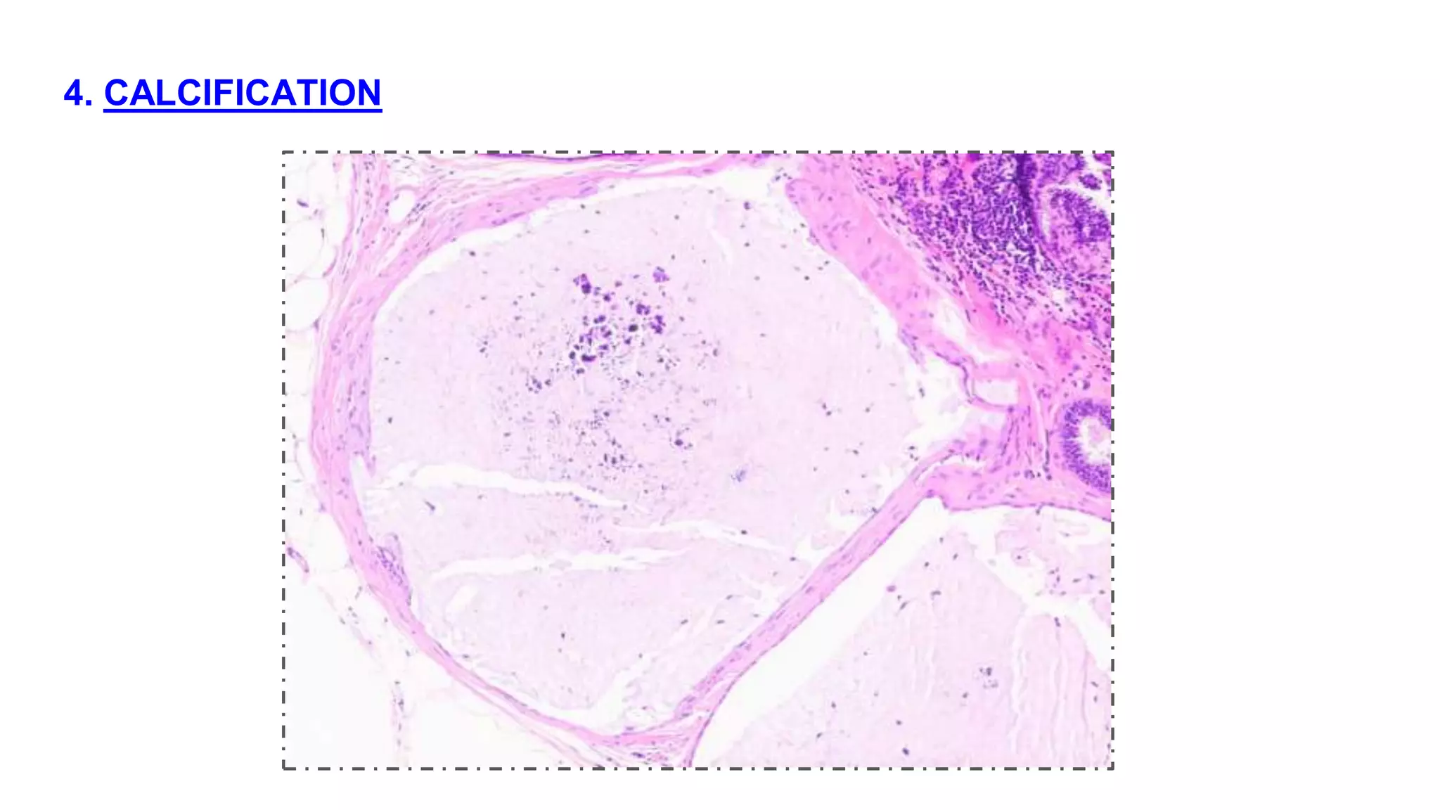 BENIGN BREAST DISEASES PATHOLOGY pptx benign-breast-diseases-pathology-pptx