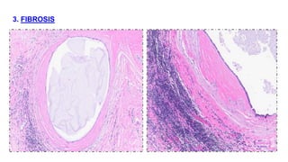 BENIGN BREAST DISEASES (PATHOLOGY).pptx