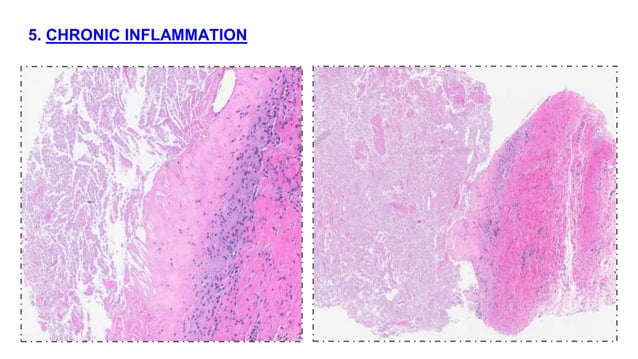 BENIGN BREAST DISEASES PATHOLOGY pptx benign-breast-diseases-pathology-pptx