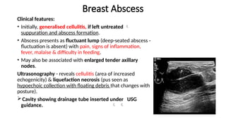 BENIGN BREAST DISORDERS / Abberation of Normal Development and ...