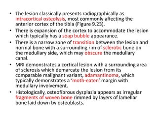 • The lesion classically presents radiographically as
intracortical osteolysis, most commonly affecting the
anterior cortex of the tibia (Figure 9.23).
• There is expansion of the cortex to accommodate the lesion
which typically has a soap bubble appearance.
• There is a narrow zone of transition between the lesion and
normal bone with a surrounding rim of sclerotic bone on
the medullary side, which may obscure the medullary
canal.
• MRI demonstrates a cortical lesion with a surrounding area
of sclerosis which demarcate the lesion from its
comparable malignant variant, adamantinoma, which
typically demonstrates a ‘moth-eaten’ margin with
medullary involvement.
• Histologically, osteofibrous dysplasia appears as irregular
fragments of woven bone rimmed by layers of lamellar
bone laid down by osteoblasts.
 