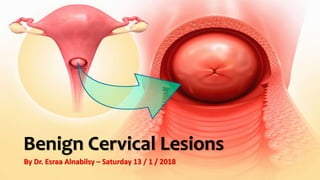 Benign Cervical Lesions
By Dr. Esraa Alnabilsy – Saturday 13 / 1 / 2018
 