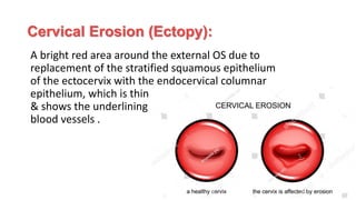 Cervical Erosion (Ectopy):
A bright red area around the external OS due to
replacement of the stratified squamous epithelium
of the ectocervix with the endocervical columnar
epithelium, which is thin
& shows the underlining
blood vessels .
 