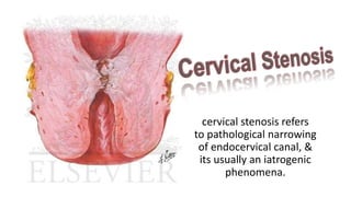 cervical stenosis refers
to pathological narrowing
of endocervical canal, &
its usually an iatrogenic
phenomena.
 