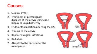 Causes:
1. Surgical event
2. Treatment of premalignant
diseases of the cervix using cone
biopsy or loup diathermy
3. Endometrial ablation affecting the OS
4. Trauma to the cervix
5. Repeated vaginal infections
6. Radiation
7. Atrophy to the cervix after the
menopause
 