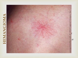 
 Fully developed hemangiomas are rare at birth
 It presents as a pale macule with thread like
telangiectasias on the skin
 Proliferative phase
 This phase lasts for a few weeks where rapid pace of
growth is observed
 6-10 months after the proliferative phase the tumour
begins to involute
 Colour changes to deep- purple hue; by the age of 5
yrs most of the red colour is gone
 Lesion feels less firm in palpation
HEMANGIOMA
Course of hemangioma…
 