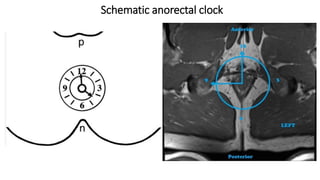 Schematic anorectal clock
 
