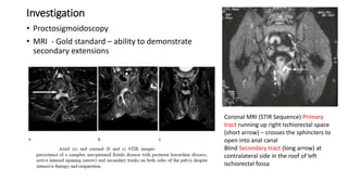 Investigation
• Proctosigmoidoscopy
• MRI - Gold standard – ability to demonstrate
secondary extensions
Coronal MRI (STIR Sequence) Primary
tract running up right Ischiorectal space
(short arrow) – crosses the sphincters to
open into anal canal
Blind Secondary tract (long arrow) at
contralateral side in the roof of left
ischiorectal fossa
 