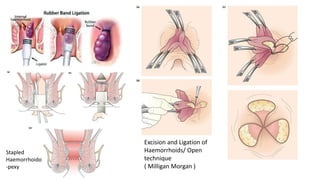 Stapled
Haemorrhoido
-pexy
Excision and Ligation of
Haemorrhoids/ Open
technique
( Milligan Morgan )
 
