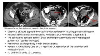 CT images of acute diverticulitis and (pericolic) diverticular abscesses
• Diagnosis of Acute Sigmoid diverticulitis with perforation resulting pericolic collection
• Hospital admission with continued IV Antibiotics ( Co-Amoxiclav 1.2 gm t.d.s )
• The collection ( pericolic abscess ) was drained percutaneously under radiological
guidance( CT-guided drainage )
• Patient was discharged Day 4 with oral antibiotics
• Review at Ambulatory Care on D7, repeated CT, resolution of the collection and
removal of drain
• FU Colorectal clinic 10 -12 weeks
 