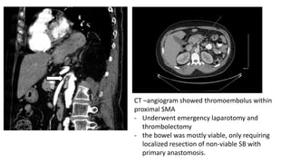 CT –angiogram showed thromoembolus within
proximal SMA
- Underwent emergency laparotomy and
thrombolectomy
- the bowel was mostly viable, only requiring
localized resection of non-viable SB with
primary anastomosis.
 