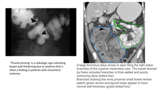 A large thrombus (blue arrow) is seen filing the right sided
branches of the superior mesenteric vein. The bowel drained
by these occluded branches is thick-walled and poorly
enhancing (blue dotted line).
Branches draining the more proximal small bowel remain
patent (green arrow) and jejunal loops appear to have
normal wall thickness (greed dotted line)
''Thumb-printing' is a radiologic sign indicating
bowel-wall thickening due to oedema that is
often a finding in patients with mesenteric
ischemia
 