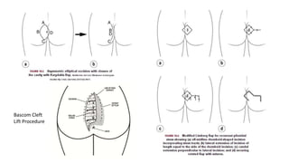 Bascom Cleft
Lift Procedure
 