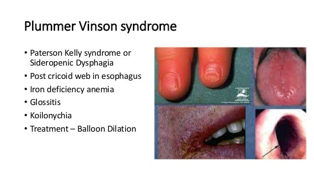 plummer vinson syndrome