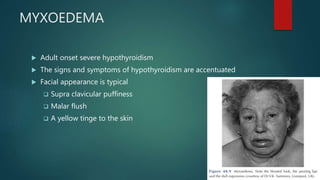 MYXOEDEMA
 Adult onset severe hypothyroidism
 The signs and symptoms of hypothyroidism are accentuated
 Facial appearance is typical
 Supra clavicular puffiness
 Malar flush
 A yellow tinge to the skin
 