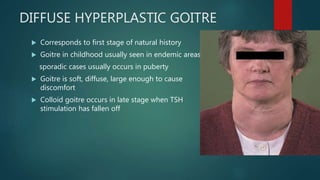 DIFFUSE HYPERPLASTIC GOITRE
 Corresponds to first stage of natural history
 Goitre in childhood usually seen in endemic areas,
sporadic cases usually occurs in puberty
 Goitre is soft, diffuse, large enough to cause
discomfort
 Colloid goitre occurs in late stage when TSH
stimulation has fallen off
 