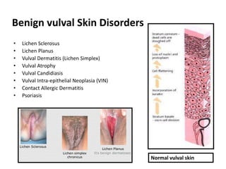 Benign Disorders of the Vulva: Pruritus (itchy) Vulva Vulval Skin and ...