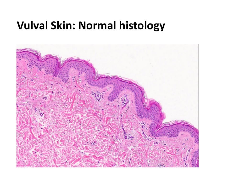 Benign Disorders of the Vulva Pruritus (itchy) Vulva Vulval Skin and…