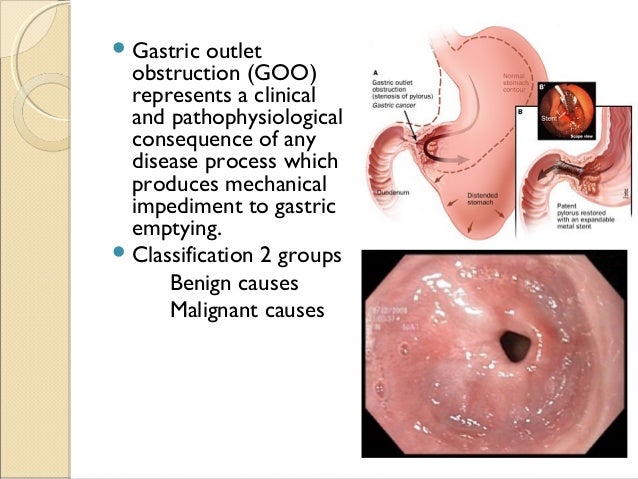 benign gastric outlet obstruction gastric outlet obstruction