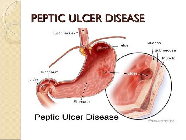 benign gastric outlet obstruction gastric outlet obstruction