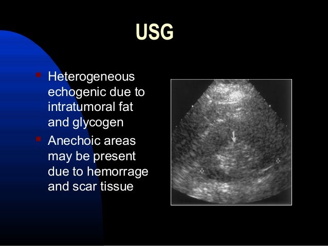 imaging of benign hepatic masses