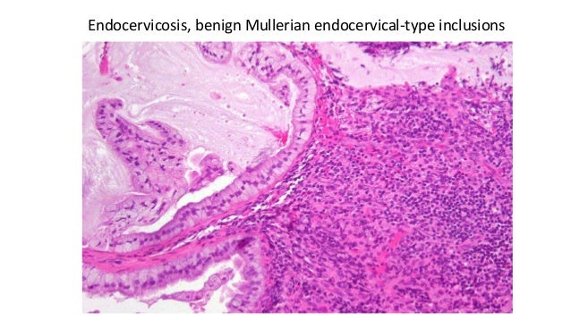 Endocervicosis of the cervix Endocervicosis of the cervix