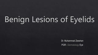 Benign Lesions of Eyelids by Dr. Muhammad Zeeshan Hameed