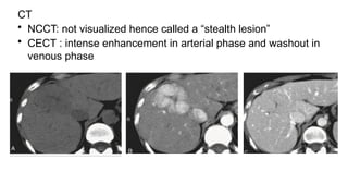 CT
• NCCT: not visualized hence called a “stealth lesion”
• CECT : intense enhancement in arterial phase and washout in
venous phase
 