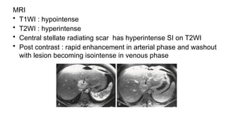 MRI
• T1WI : hypointense
• T2WI : hyperintense
• Central stellate radiating scar has hyperintense SI on T2WI
• Post contrast : rapid enhancement in arterial phase and washout
with lesion becoming isointense in venous phase
 