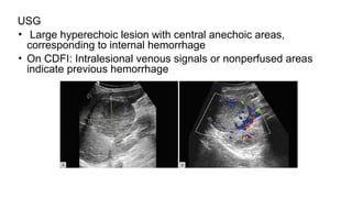 USG
• Large hyperechoic lesion with central anechoic areas,
corresponding to internal hemorrhage
• On CDFI: Intralesional venous signals or nonperfused areas
indicate previous hemorrhage
 