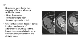 CT
• Hypodense mass due to the
presence of fat and glycogen
within the tumor.
• Hyperdense areas
corresponding to fresh
hemorrhage can be noted
• CECT : enhancement does not persist
in adenomas because of
arteriovenous shunting and the
lesions become nearly isodense to
normal liver in portal venous and
delayed scans.
 