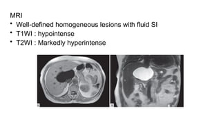 MRI
• Well-defined homogeneous lesions with fluid SI
• T1WI : hypointense
• T2WI : Markedly hyperintense
 