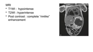 MRI
• T1WI : hypointense
• T2WI : hyperintense
• Post contrast : complete “rimlike”
enhancement
 