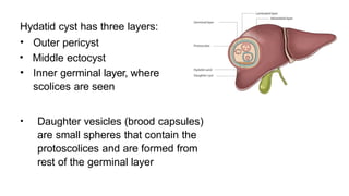 Hydatid cyst has three layers:
• Outer pericyst
• Middle ectocyst
• Inner germinal layer, where
scolices are seen
• Daughter vesicles (brood capsules)
are small spheres that contain the
protoscolices and are formed from
rest of the germinal layer
 