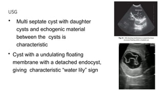 USG
• Multi septate cyst with daughter
cysts and echogenic material
between the cysts is
characteristic
• Cyst with a undulating floating
membrane with a detached endocyst,
giving characteristic “water lily” sign
 