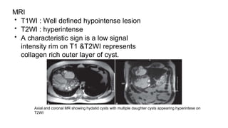 MRI
• T1WI : Well defined hypointense lesion
• T2WI : hyperintense
• A characteristic sign is a low signal
intensity rim on T1 &T2WI represents
collagen rich outer layer of cyst.
Axial and coronal MR showing hydatid cysts with multiple daughter cysts appearing hyperintese on
T2WI
 